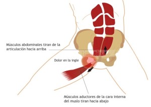 Lesion Atleta Pubalgia  300x212 - TRATAMIENTO Y PREVENCIÓN DE LA PUBALGIA