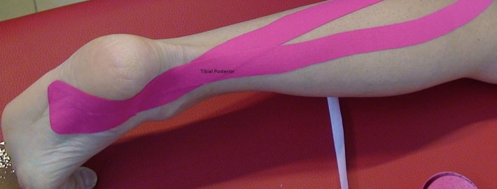 Los efectos del vendaje neuromuscular o kinesiotape Tibial Posterior 3 710x270 - Los efectos del vendaje neuromuscular o kinesiotape